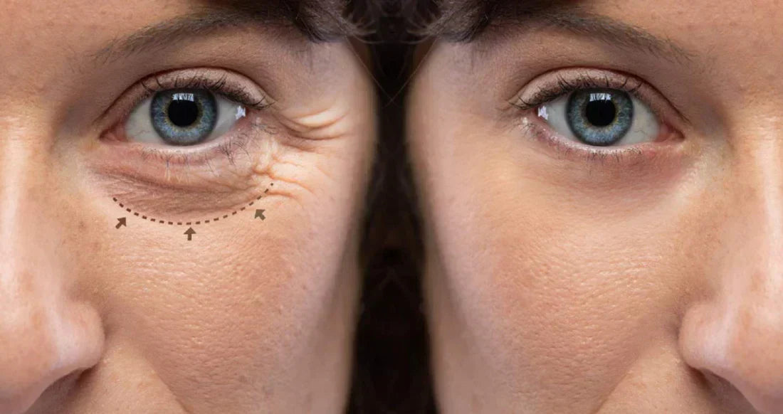 Eyelight - Say Goodbye to Dark Circles & Puffy Eyes